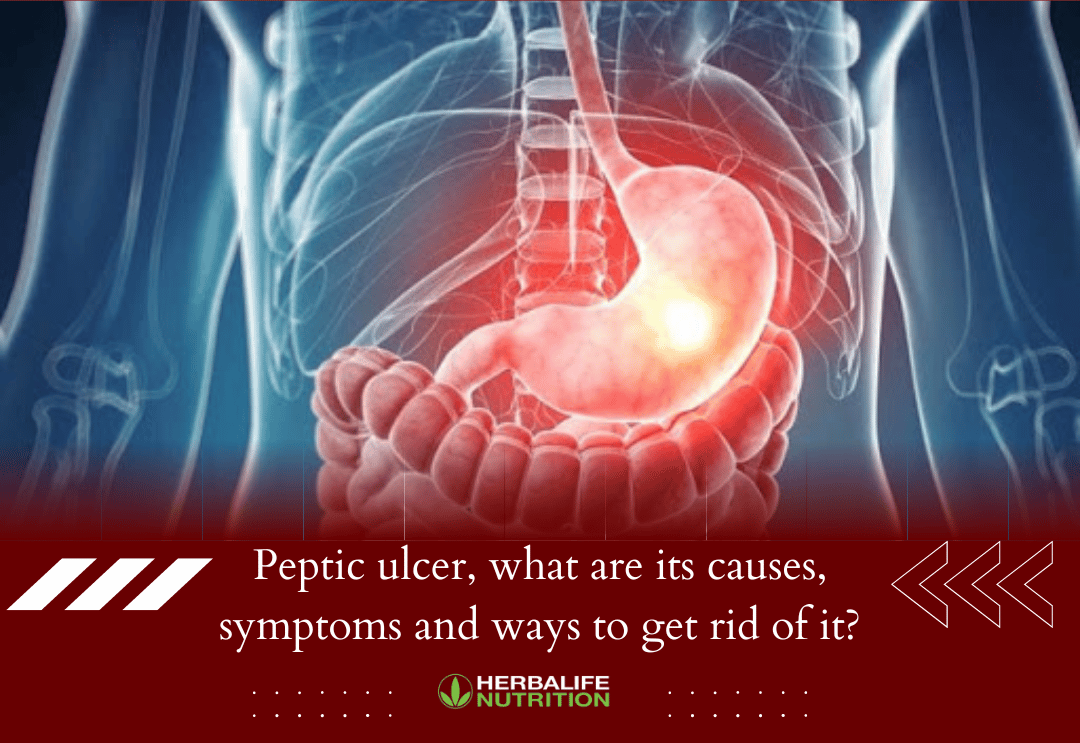 A peptic ulcer is an open sore that develops on the inner lining of the stomach